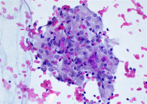 Pathology Outlines Granulomatous Inflammation