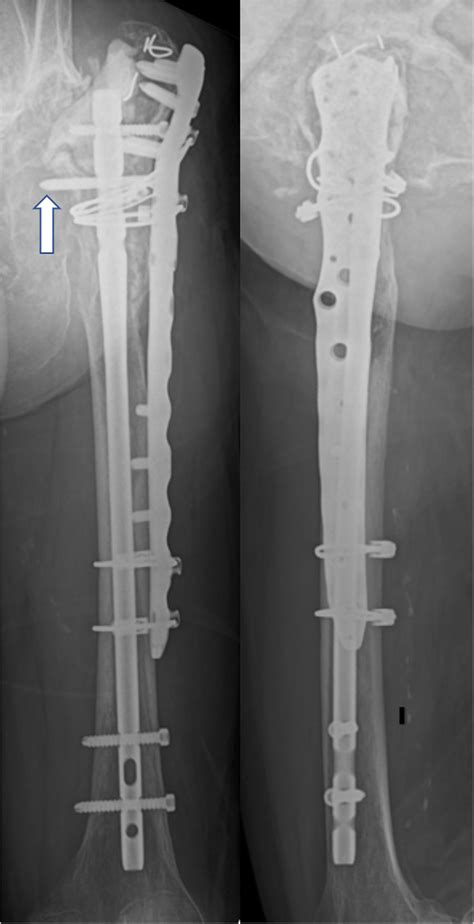 Postoperative Plain Radiographs Of The Left Femur Left Download