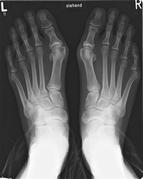 Bunion | Pain, Treatment & Surgery | Britannica