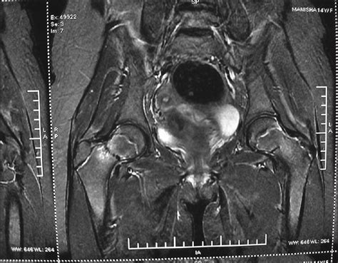 FEMORAL NECK FRACTURE – Agile Ortho