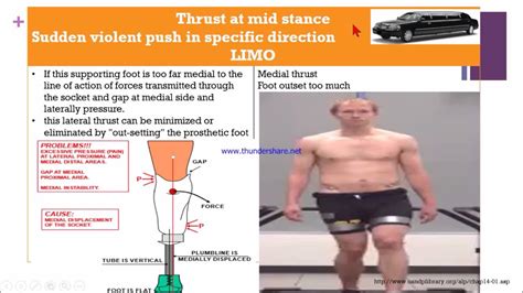 Transtibial Gait Deviation YouTube