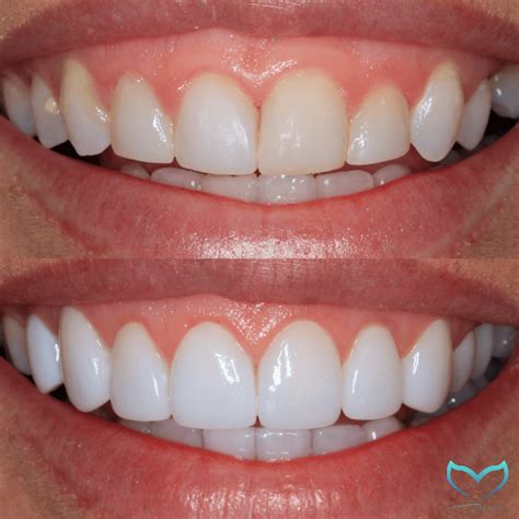 Composite Vs Porcelain Veneers You Need Everything