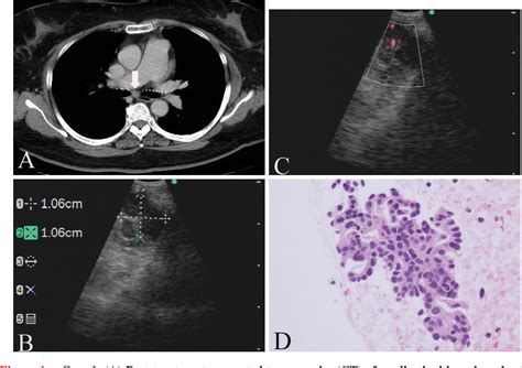 Figure From Restaging By Endobronchial Ultrasound Guided