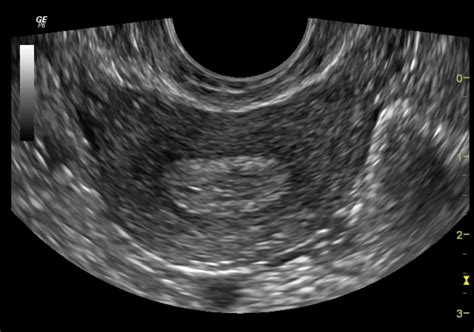 Normal Pelvic Ultrasound Transvaginal Image Radiopaedia Org