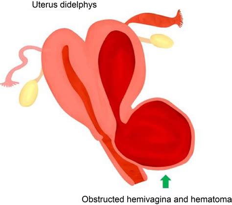 An Image Showing Uterus Didelphys And Obstructed Hemivagina Filled