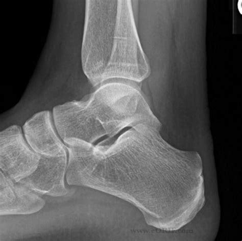 Lateral Foot X Ray Hot Sex Picture