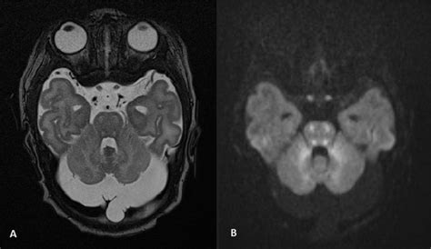 Distinctive Magnetic Resonance Imaging Findings In Neonatal Nonketotic Hyperglycinemia