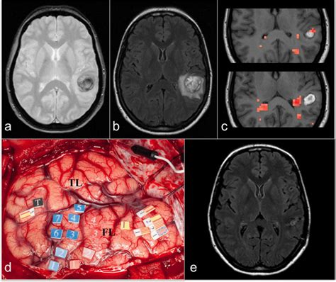 A T2 Weighted Image Mri Showing A Left Parieto Temporal Cavernous