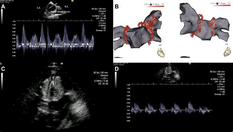 Zero Fluoroscopy Pulmonary Vein Isolation With Intracardiac