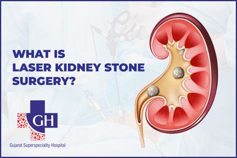 What Is Laser Kidney Stone Surgery?