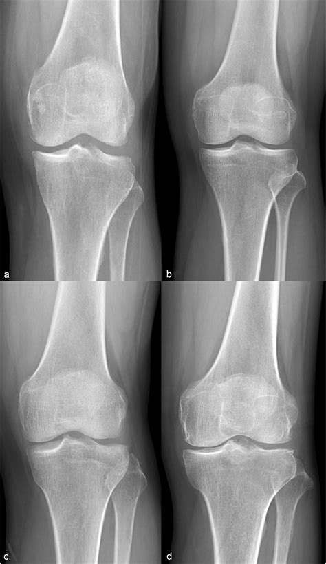 Qualitative And Quantitative Measures In The Infrapatellar Fat Pad In