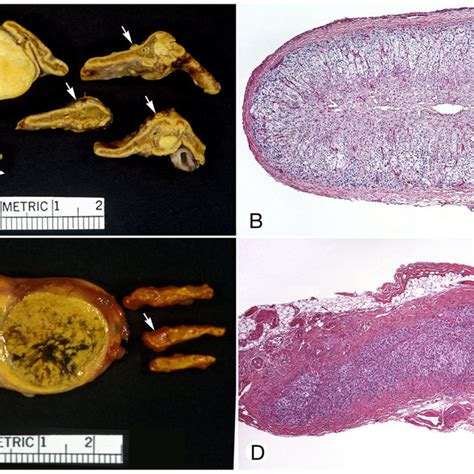 Adrenocortical Adenoma A Clear Cells And An Irregularly Shaped Zone Download Scientific