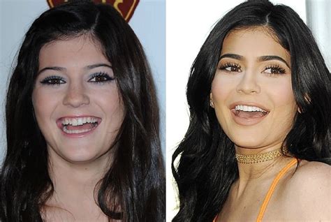 Kylie Jenner Before and After Plastic Surgery: Lips, Face, Body