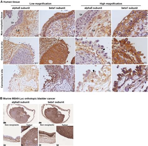 Expression of α5 and β1 integrins in human bladder CIS and murine