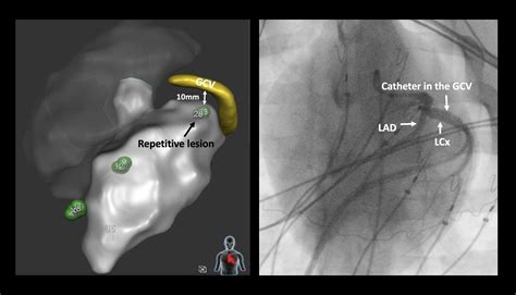 Pulsed Field Ablation In Ventricular Myocardium Using A Focal Catheter