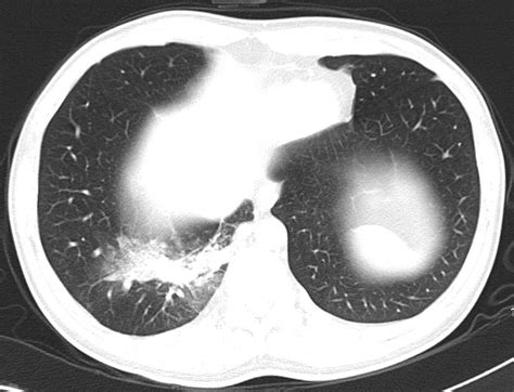 Radiodiagnosis Imaging Is Amazing Interesting Cases Intralobar