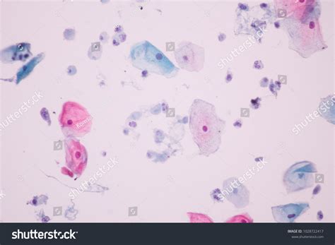 Trichomonas Pap Smear Cytology View Microscopicgynecology Stock Fotografie 1028722417 Shutterstock