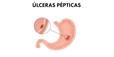 Al D A En Salud Lceras P Pticas