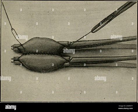 Operative Surgery For Students And Practitioners Fig 210 Posterior