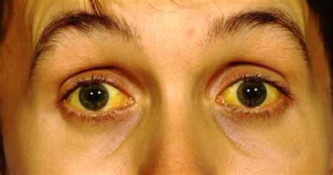 Jaundice Symptoms Causes Diagnosis And Homoeopathic Treatment Of