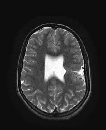 Closed Lip Schizencephaly