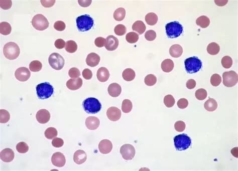 Autoimmune Haemolytic Anaemia Learnhaem Haematology Made Simple