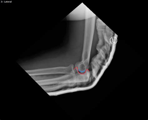 Druj Elbow Xray Lateral Post Reduction Annotated Jetem 2020 Jetem