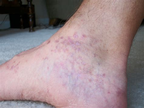 Treatment For Red Itchy Rash On Feet At Michael Nehls Blog