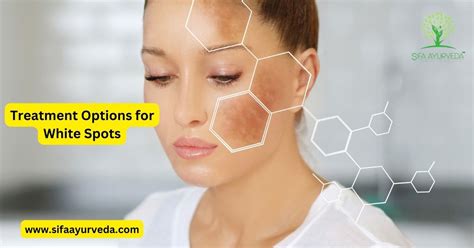 Why You Might Have White Spots On Your Skin Sifa Ayurveda 100