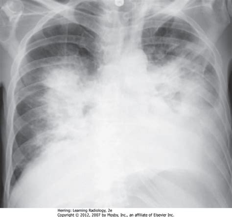 ACCS CRT RRT Chest X Ray Pics Flashcards Quizlet