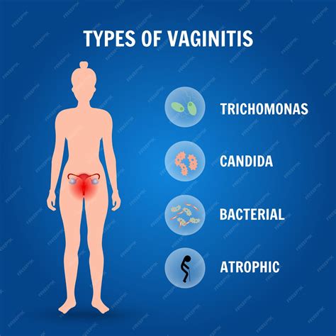 Tipos de infográfico médico de vaginite em ilustração vetorial | Vetor Premium
