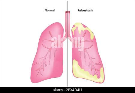 Vector Illustration Of Asbestos Lung Disease Asbestosis Stock Vector