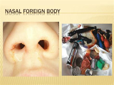 Ppt Otorhinolaryngology Disorders Of The Ear Nose And Throat