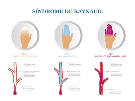 Syndrome De Raynaud Traitement Causes Diagnostic De Quoi S Agit Il