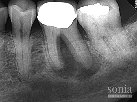 Many Things Dental Imaging Can Tell You: Root Resorption Treatment