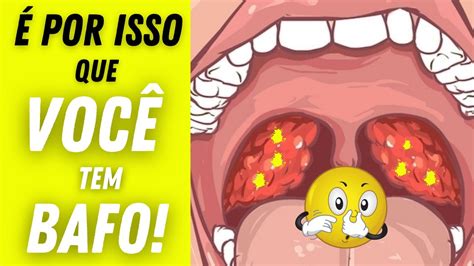 C Seo Amigdaliano Massinhas Fedidas Na Garganta Livre Se Delas Dr