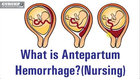 What Is Antepartum Hemorrhagenursing Youtube