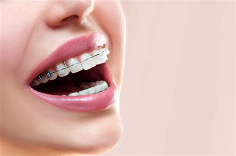 The Benefits Of Adult Braces Beyond Aesthetics Jacobus Orthodontics