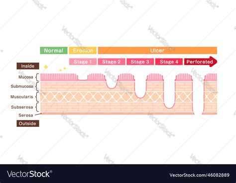 Stages Of Gastric Ulcer Stomach Ulser Royalty Free Vector