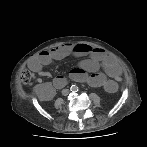 Small Bowel Obstruction Radiologypicscom