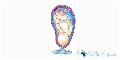 Ruptura Prematura De Membranas Rpm Plan De Cuidados De Enfermer A Y