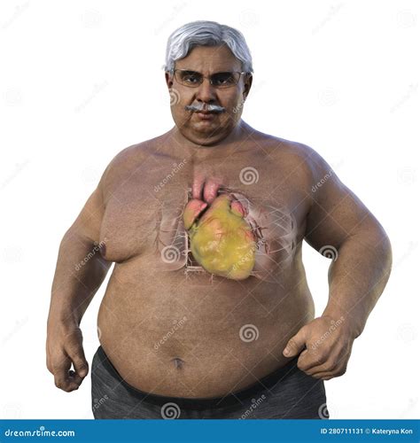 Obese Heart Illustration 105933817