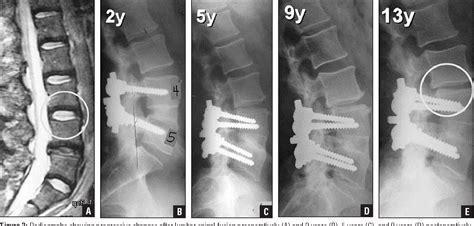 Adjacent Segment Disease Causes Symptoms And Treatment Bonati