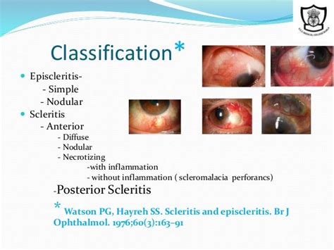 Scleritis And Episcleritis