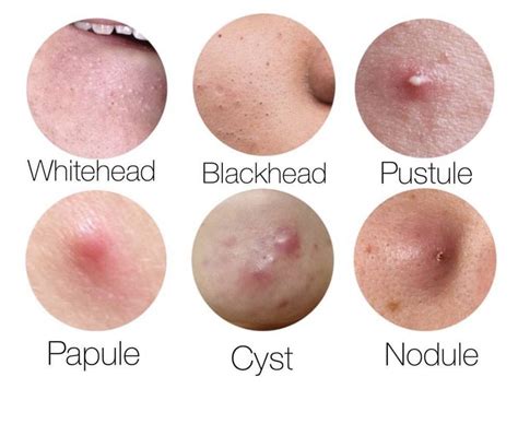 Acne Types