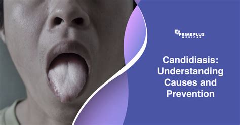 Candidiasis: Understanding Causes and Prevention - Prime Plus Medical