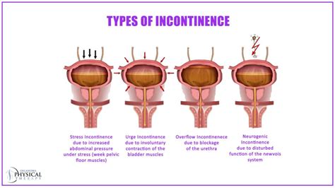 Explore The Symptom Causes And Treatments Of Urinary Incontinence