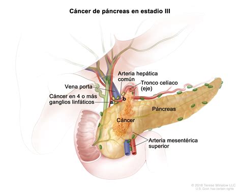 Tratamiento Del C Ncer De P Ncreas Nci