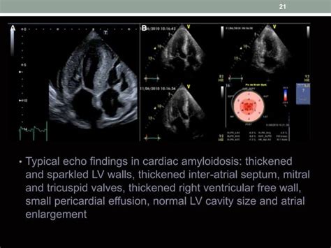 Cardiac Amyloidosis Ppt