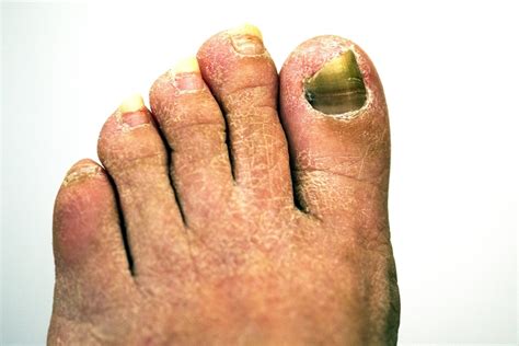 how to get rid of toe fungus naturally